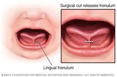 Apex Dental- Tongue Thrust