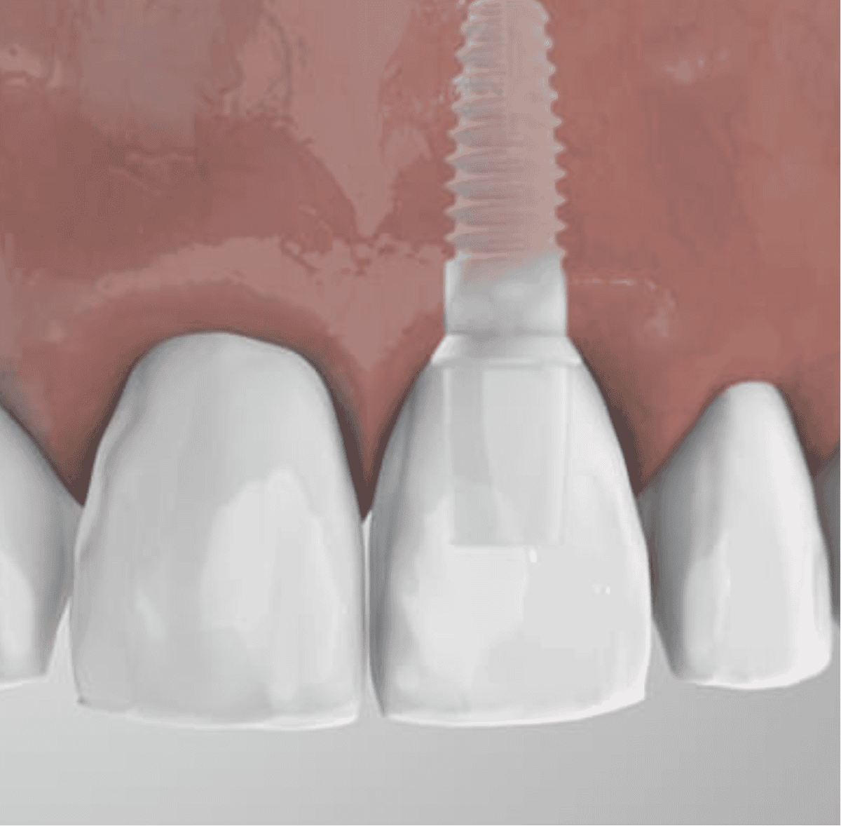 Ceramic Dental Implants in Des Moines Apex Dental